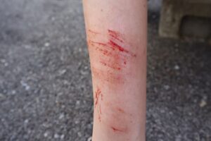 Understanding Road Rash and Its Consequences